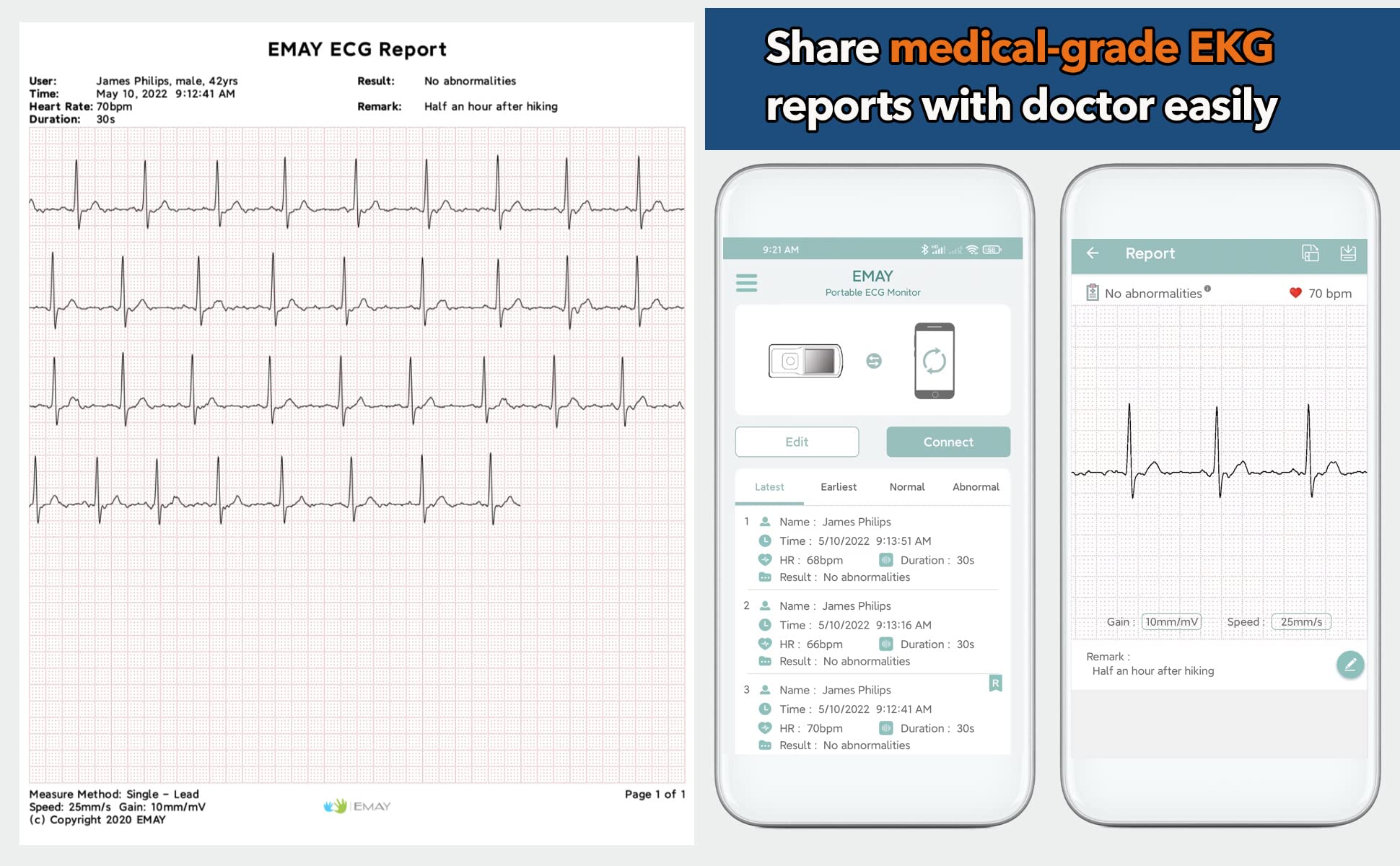 EMAY Bluetooth Portable ECG/EKG Monitor (for iPhone & Android, Mac & Windows)   Wireless Personal ECG Monitor Works with Smartphones   Records Rhythm & Heart Rate, Gives Instant Detections (EMG-20)